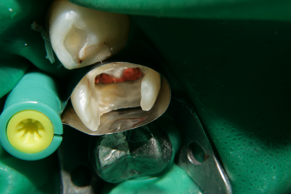 Върху зъба е нанесен кондиционер